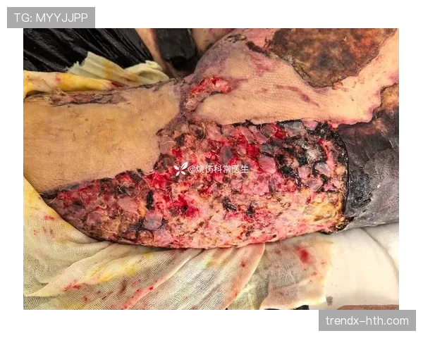 库尔图瓦手术后恢复计划 库尔图瓦手术后恢复计划